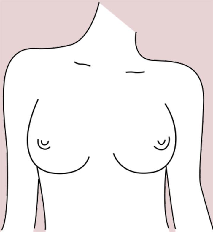 Side Set breast shape